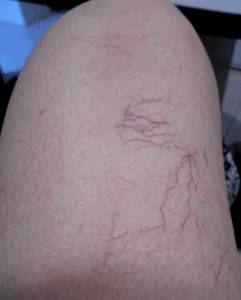 a leg showing spider veins