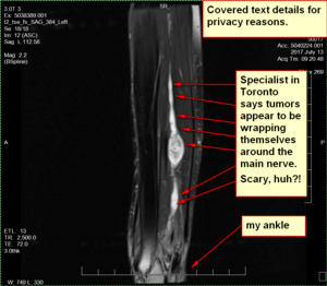MRI view of my lower left leg