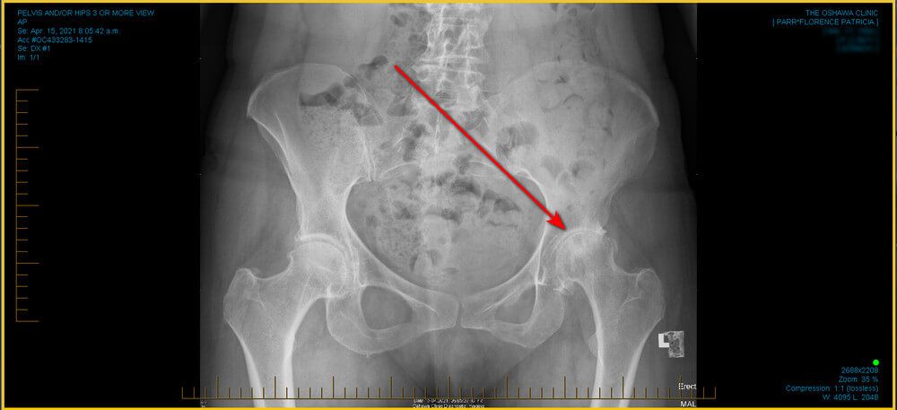 image of my hips x-ray