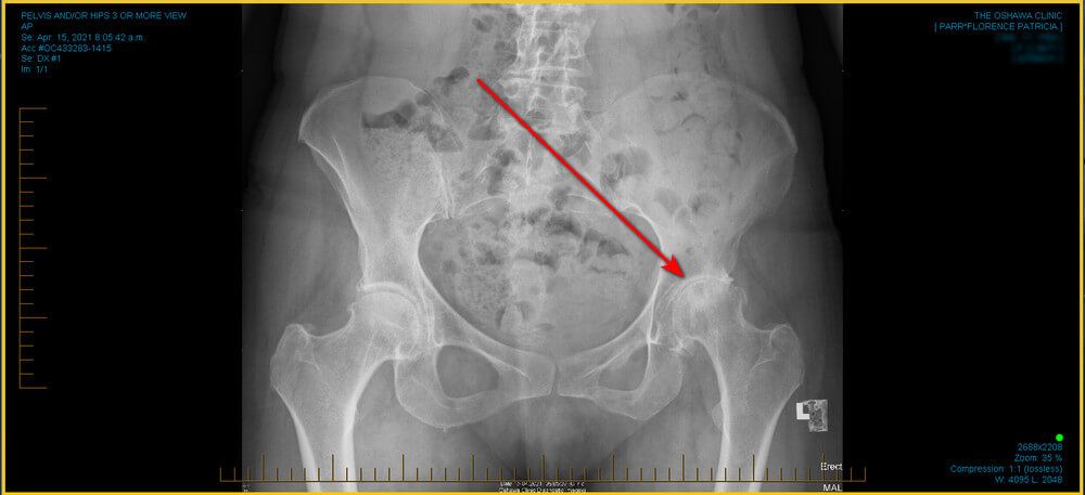 Total Hip Replacement - Which Procedure Should You Go With? - Trish's ...