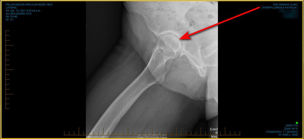 right hip x-ray showing cartilage still mostly present