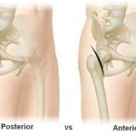 image showing where incisions are made for posterior vs anterior procedure