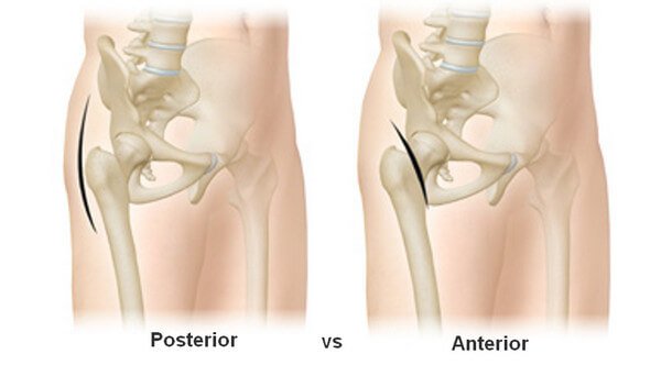 image showing where incisions are made for posterior vs anterior procedure