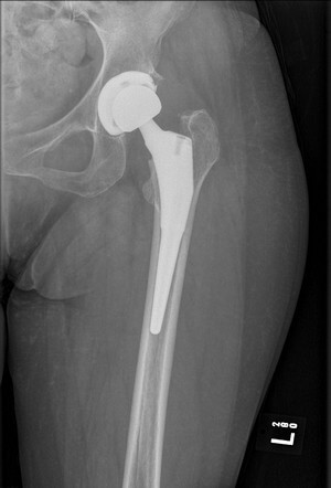 x-ray of my left hip with hip replacement